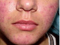 Acne-rosacea-Carbo-animalis