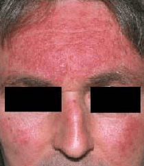 Acne-rosacea-calcarea-fluorica