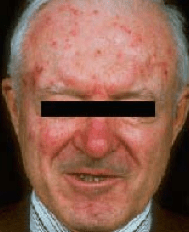 Acne-rosacea-eugenia-jambonosa