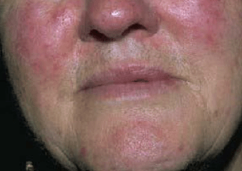 Acne-rosacea-sanguinaria-canadensis