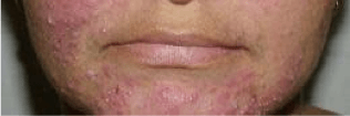 Acne-rosacea-sepia